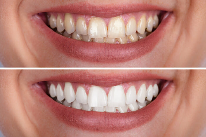 teeth whitening before ad after