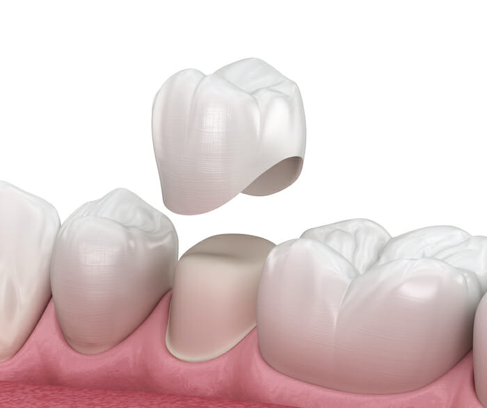 dental crowns