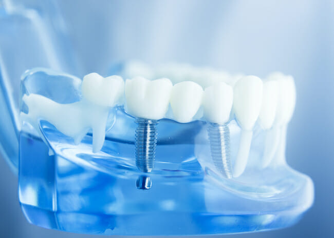 dental implants