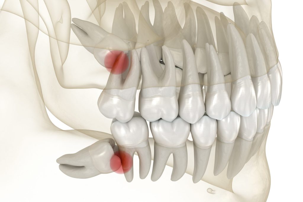 Do Wisdom Teeth Always Need to Be Removed? When an Extraction May Be Recommended